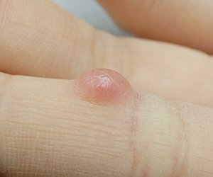 皮膚腫瘍(できもの)の種類:後天性指趾被角線維腫(こうてんせいししひかくせんいしゅ)