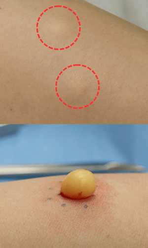 皮膚腫瘍(できもの)の種類:多発性脂腺嚢腫