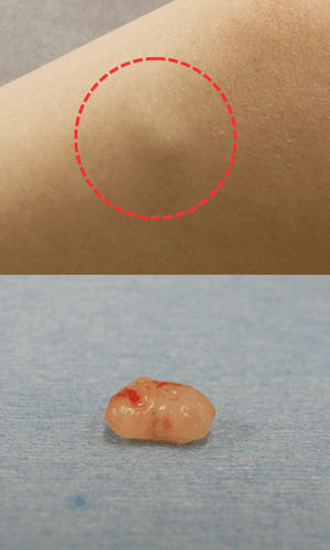 皮膚腫瘍(できもの)の種類:血管平滑筋腫