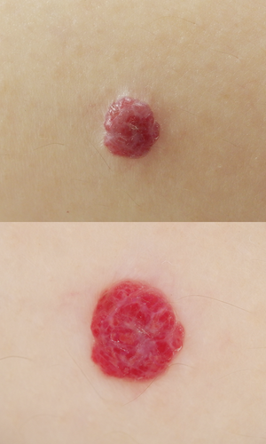 皮膚腫瘍(できもの)の種類:血管腫の症例1