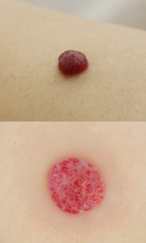 皮膚腫瘍(できもの)の種類:血管腫の症例2