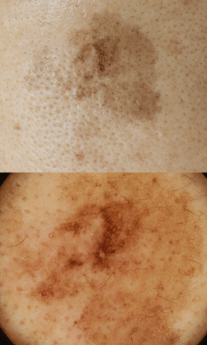 皮膚腫瘍(できもの)の種類:悪性黒色腫(あくせいこくしょくしゅ:メラノーマ)