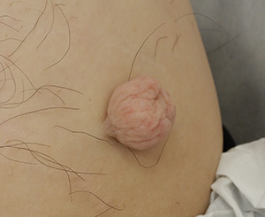 皮膚腫瘍(できもの)の種類:表在性皮膚脂肪腫性母斑(ひょうざいせいひふしぼうしゅせいぼはん)の症例