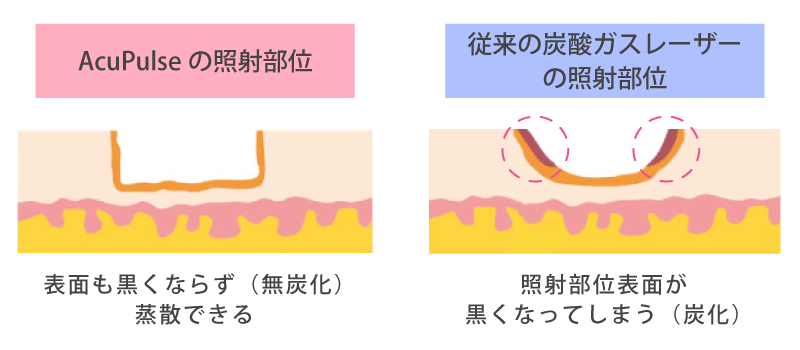 AcuPulseと従来レーザーとの比較