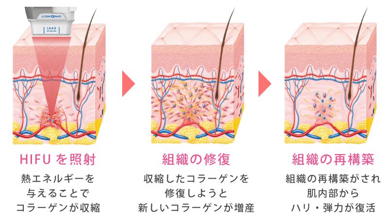 医療HIFU(ハイフ)の効果