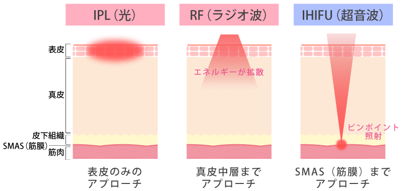 医療HIFU(ハイフ)と従来機械との違い