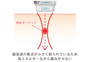 少ない痛みで高エネルギー照射が可能