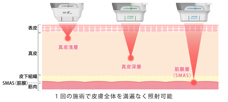 照射深度を調整して徹底的に若返り