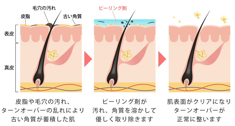 ケミカルピーリングの効果とメリット