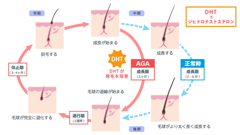AGA(男性型脱毛症)の原因