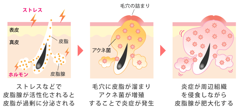 難治性ニキビの原因