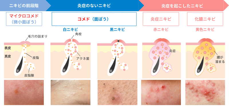 ニキビの進行と症状