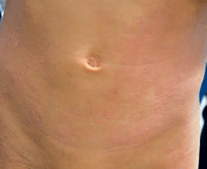 アトピー性皮膚炎の症状：幼児期・学童期（2～12歳）