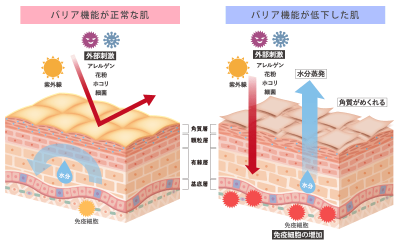 アトピー性皮膚炎の原因