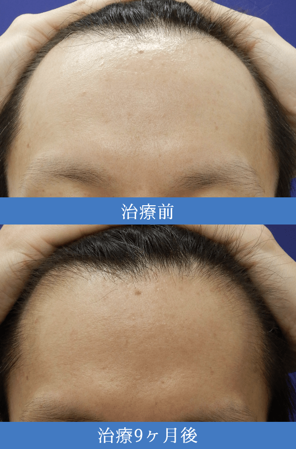 AGA(男性型脱毛症)治療の症例1