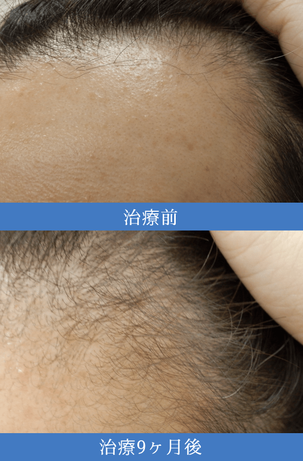 AGA(男性型脱毛症)治療の症例3