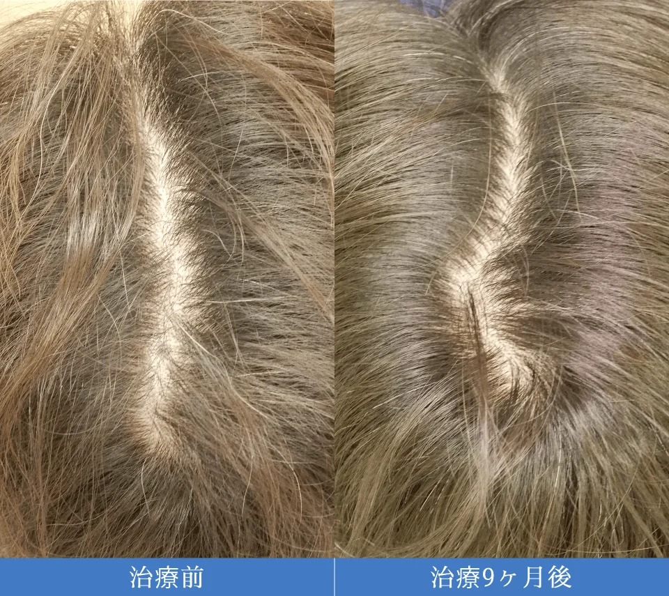 AGA(男性型脱毛症)治療の症例4