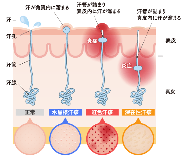 あせも（汗疹）症状の種類