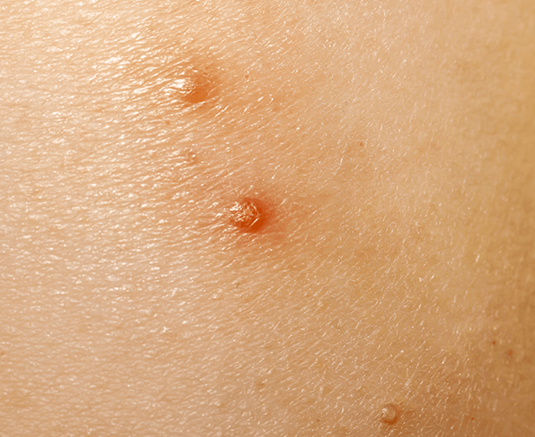イボ（伝染性軟属腫）の症状