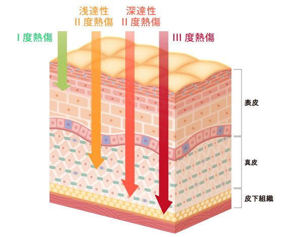 やけど(熱傷)の症状