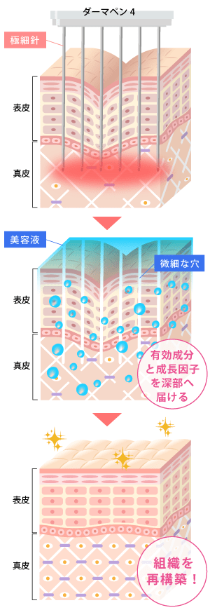 ダーマペン4で有効成分と成長因子を肌深部へ届ける