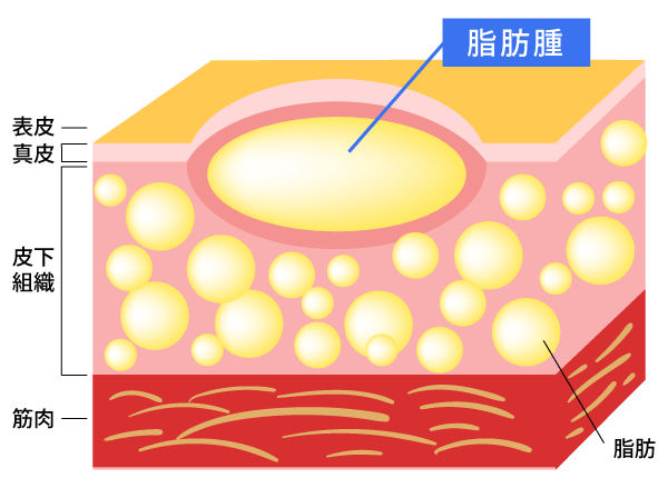 脂肪腫の原因