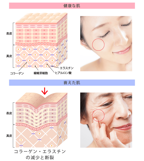 ダーマペン4の美肌効果