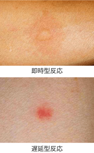 虫刺され（虫刺症）の症状