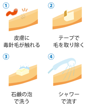 毛虫皮膚炎の対処法