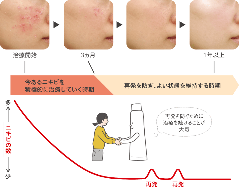 ニキビ治療は根気よく続けることが大切
