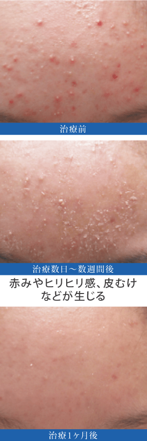 コメド治療の注意点