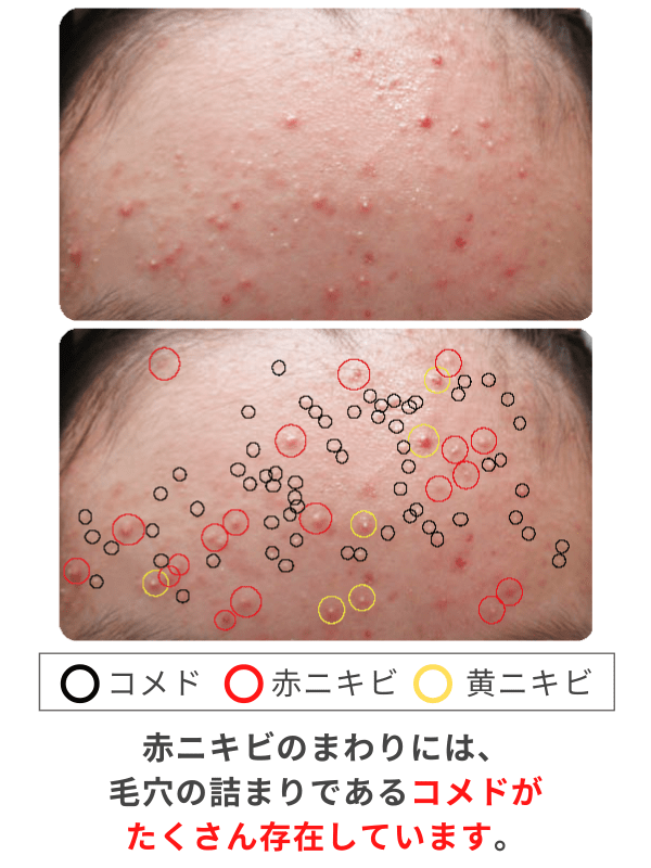 コメド(面ぽう)とは?