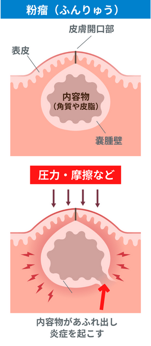 粉瘤(ふんりゅう・アテローム)の原因