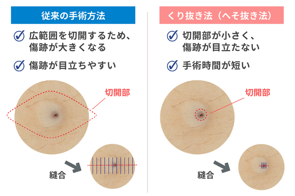 粉瘤(ふんりゅう・アテローム)の治療法の比較