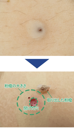 粉瘤(ふんりゅう・アテローム)の治療「くり抜き法」症例写真1