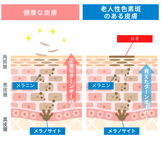 老人性色素斑(ろうじんせいしきそはん:日光黒子)の原因