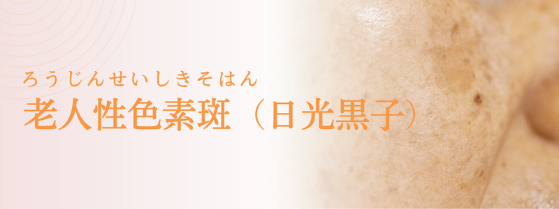 老人性色素斑（ろうじんせいしきそはん：日光黒子）の治療法