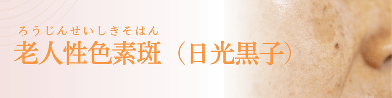 老人性色素斑（ろうじんせいしきそはん：日光黒子）の治療法