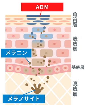 ADM(後天性真皮メラノサイト―シス)の原因