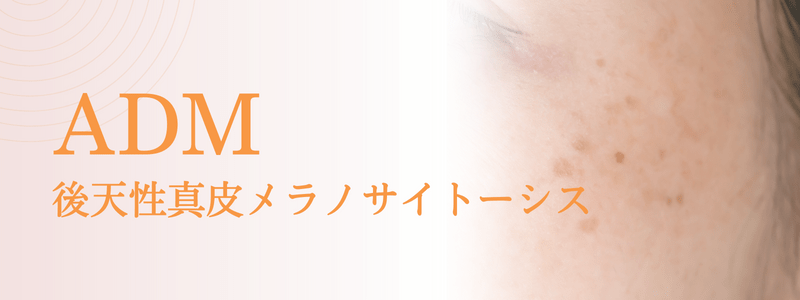 ADM（後天性真皮メラノサイト―シス）の治療法