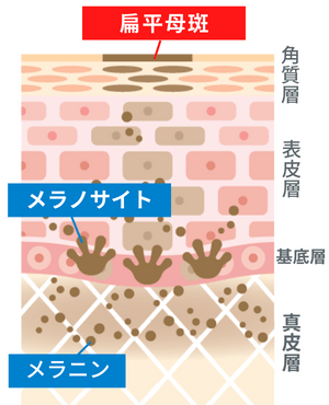 扁平母斑(へんぺいぼはん:茶あざ)の原因