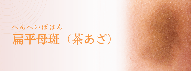 扁平母斑（へんぺいぼはん：茶あざ）の治療法