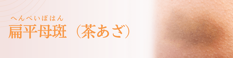 扁平母斑（へんぺいぼはん：茶あざ）の治療法