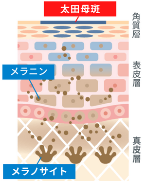 太田母斑(おおたぼはん:青あざ)の原因