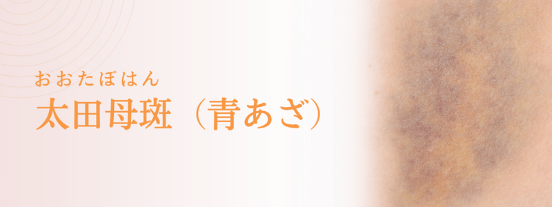 太田母斑（おおたぼはん：青あざ）の治療法