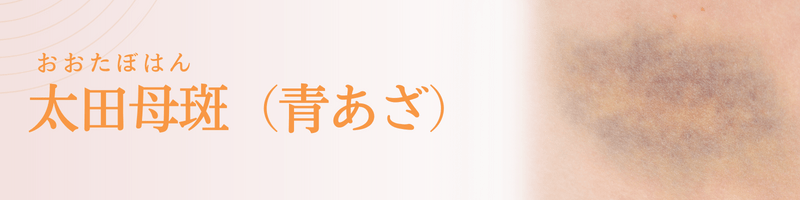 太田母斑（おおたぼはん：青あざ）の治療法