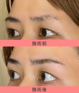 医療アートメイク:4Dストローク眉 症例3