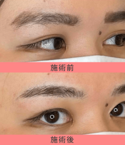 医療アートメイク:4Dストローク眉 症例7