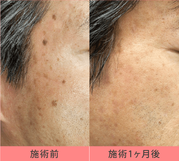 老人性イボ(脂漏性角化症)の当院症例(40代男性)1