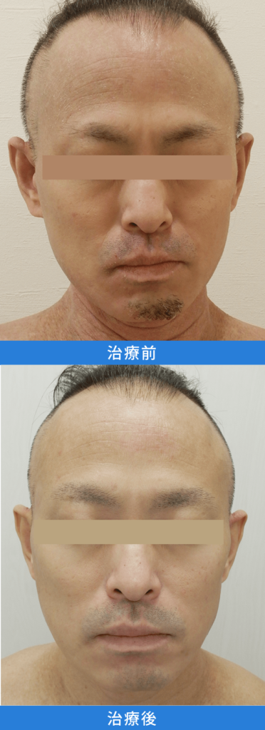 アトピー性皮膚炎治療 デュピクセント症例写真：全顔